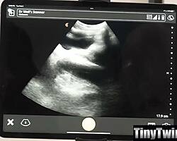 डॉक्टर टिनी 18+ ट्विंक पेशेंट को बेयरबैक चोदता है।